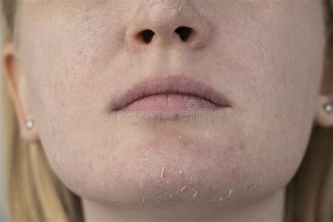 A Woman Examines Dry Skin On Her Face Peeling Coarsening Discomfort