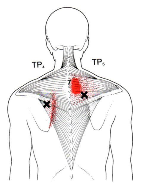 The Trigger Point And Referred Pain Guide 19