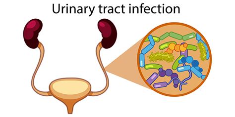 Urinary Tract Infections Types Causes And Treatment Options Gauri