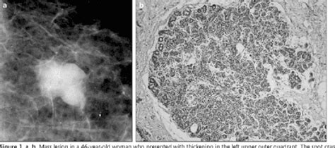 Figure 3 From Sclerosing Adenosis Of The Breast Radiologic Appearance