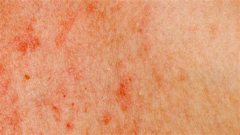 Leukemia Rash Pictures Symptoms And When To See A Doctor