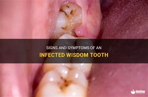 Signs And Symptoms Of An Infected Wisdom Tooth Medshun