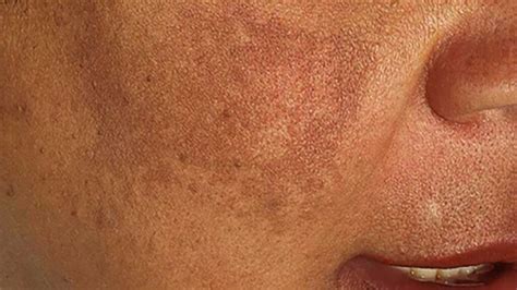 Hyperpigmentation Types Treatment And Causes