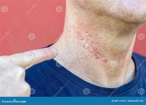 Skin Irritation After Cosmetic Surgery Stock Image Image Of Surgery
