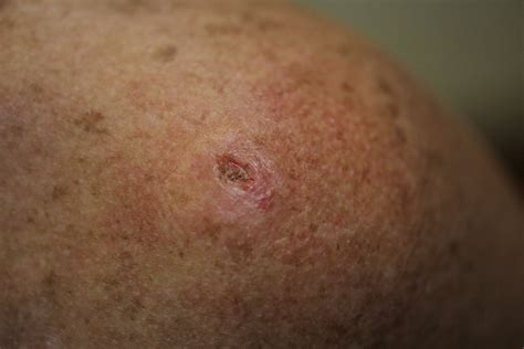 Images Of Skin Cancer