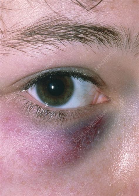 Black Eye Periorbital Bruising Stock Image M Science Photo Library