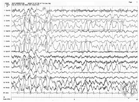 Eeg Interpretation In Childhood Epilepsies Neupsy Key