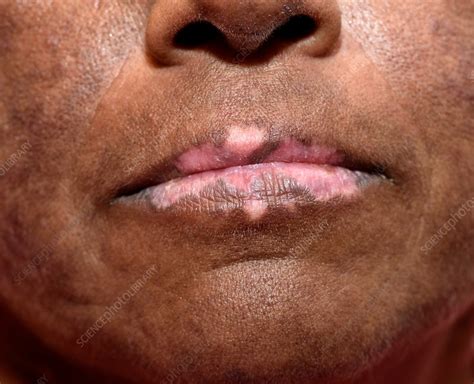 Discoid Lupus Erythematosus Oral Lesions