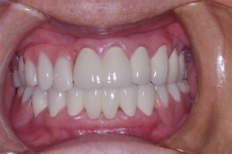 Partial Dentures For Upper Front Teeth