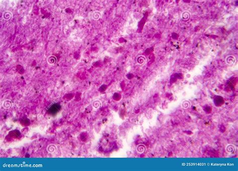 Purulent Meningitis Light Micrograph Stock Image Image Of Microscope