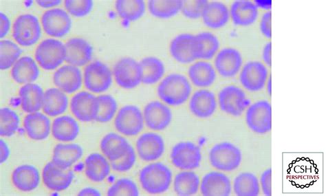 The Hemoglobin E Thalassemias