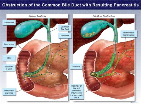 Obstruction Of The Common Bile Duct With Resulting Pancreatitis Trialexhibits Inc