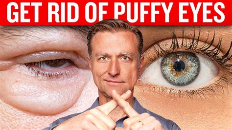 Get Rid Of Puffy Eyes For Good With Dr Bergs Proven Techniques Youtube