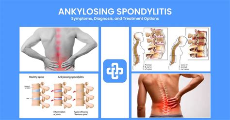 ankylosing spondylitis symptoms diagnosis and treatment options manage patient