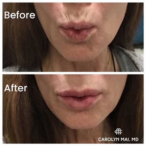 The Best Treatments For Lip Lines Botox Vs Fillers Dr Carolyn Mai