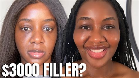 vlog cheek filler before and after black skin youtube