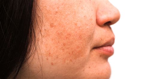 Here Is Everything You Need To Know About Melasma Causes And