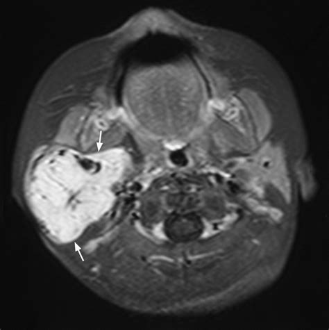 Imaging Of Salivary Gland Tumours European Journal Of Radiology