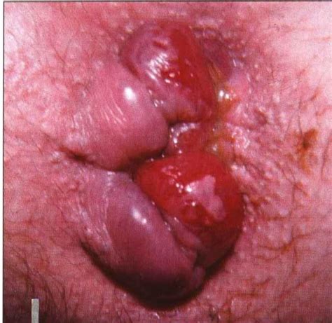 The acute management of haemorrhoids. This Stage Of Internal Hemorrhoids Are Not Visible During ...