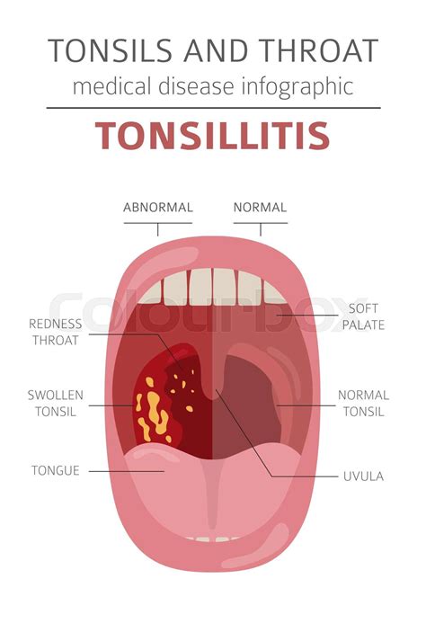 Anatomi Tonsillitis Dårlig Stock Vektor Colourbox