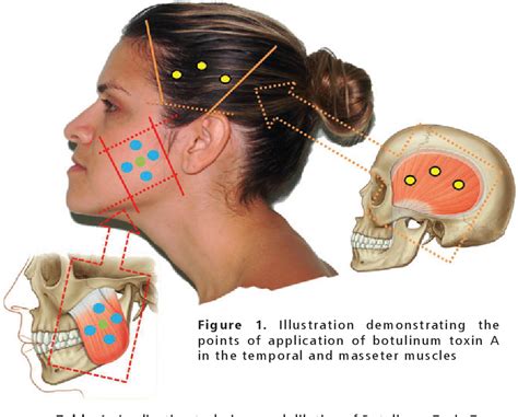 Figure 1 From Use Of Botulinum Toxin For The Treatment Of Bruxism In