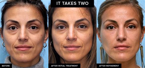 How To Get The Best Filler Results Updated 2023 Mabrie Facial Institute