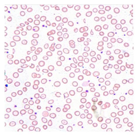 Peripheral Smear From A Patient With Concomitant Iron Deficiency And