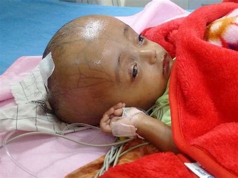 This 9 Month Old Baby Suffers Due To Fluid Accumulating In His Brain