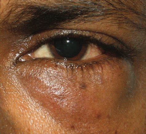 Painless Slowly Growing Mass In The Lower Eyelid Of A 42 Year Old