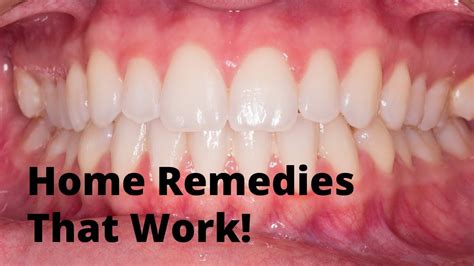 Home Remedies For Receding Gums Youtube