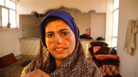 Afghan Wife Maimed For Refusing Drug Addict Husbands Cash Demands Cnn