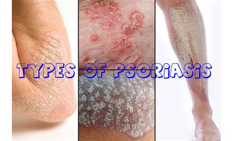 Types Of Psoriasis What Types Of Psoriasis Are There