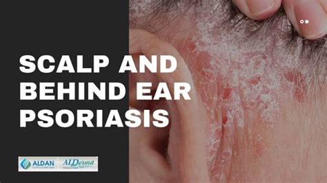 Scalp And Behind Ear Psoriasis Removing Psoriasis From Ears