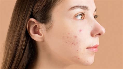 Nodular Acne Causes Treatment Home Remedies And Prevention Zwivel