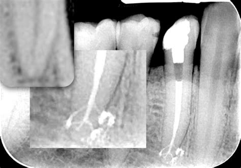 endodontic obturation techniques the state of the art in 2015 dentistry today ce