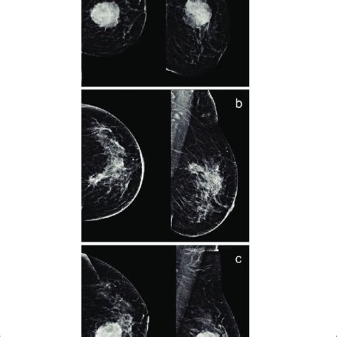 Mammogram Images Of A 50 Year Old Female Patient Who Initially