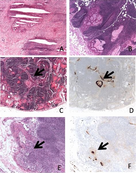 Representative Frozen Sections Of Sentinel Lymph Node Macrometastases