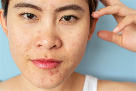 How To Treat Hormonal Acne Naturally