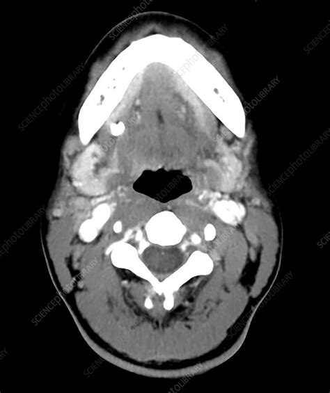 Submandibular Duct Stone Ct Scan Stock Image C0306398 Science