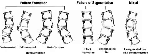 Congenital Scoliosis Spine Orthobullets