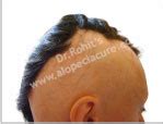 Alopecia totalis, alopecia universalis, patchy alopecia areata, ophiasis, diffuse alopecia areata, alopecia areata of the nails, nonscarring alopecia. Alopecia Areata Natural & Herbal Treatment - Patchy Hair ...