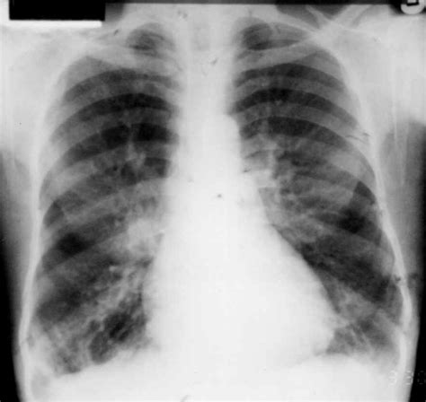 Difference Between Chronic Bronchitis And Emphysema