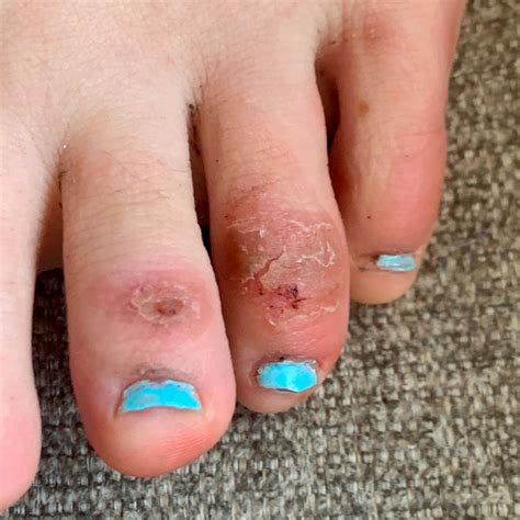 ‘covid Toes Other Rashes Latest Possible Rare Virus Signs The