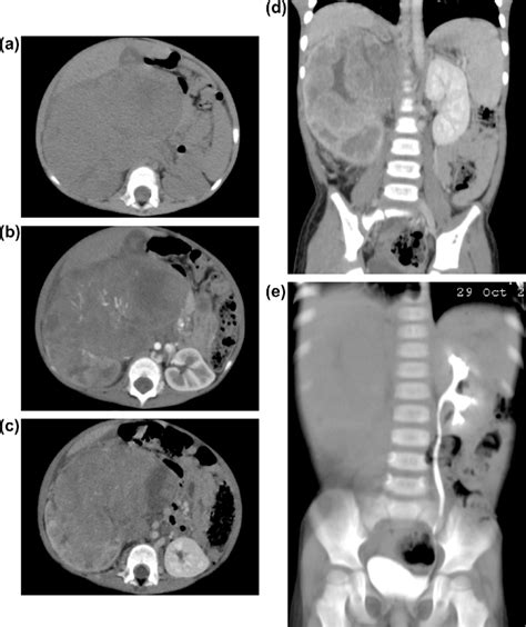 A Axial Ct Scan In The Pre Contrast Phase Of The Abdomen Revealing