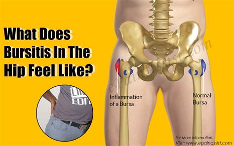 What Causes Hip Bursitis Images And Photos Finder