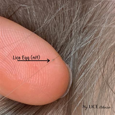 Lice Vs Dandruff 7 Key Differences Between Lice Eggs And Dandruff In
