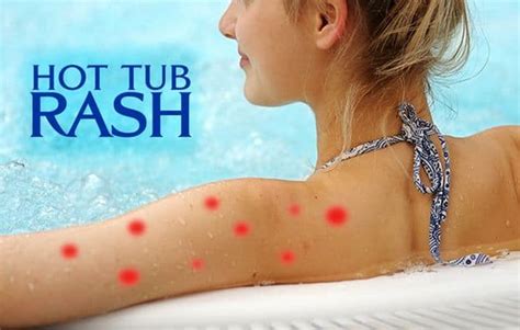 Hot Tub Rash Truth As Chemical Free As Your Spa Can Be