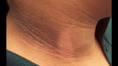 Home Remedies To Get Rid Of The “black Neck” Acanthosis Nigricans
