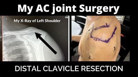 What To Expect From A Distal Clavicle Resection Surgery Ac Joint