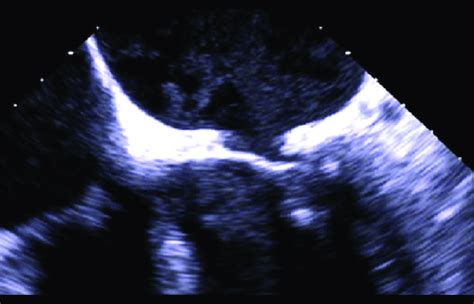Preoperative Transesophageal Echocardiogram Tee Showing Mitral Valve